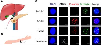 Portal Venous Circulating Tumor Cells Undergoing Epithelial-Mesenchymal Transition Exhibit Distinct Clinical Significance in Pancreatic Ductal Adenocarcinoma